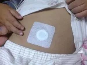 小兒積滯，秘密武器來幫你——敷貼器